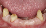 The mandibular teeth are prepared for a conventional bridge.
