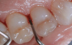 Periodontal probe demonstrates bleeding on probing and marginally deep pocket depth.