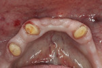 Complete, effective retraction of the gingiva is achieved.