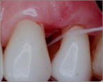 Fig 1. Floss is ineffective in interproximal areas that have concave areas.