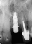 Figure 5  Periapical radiograph of the NanoTite PREVAIL 4/5/4 x 11.5-mm Implant placed in a single-stage protocol.