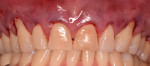 Fig 6. Teeth following mechanical debridement and reduction of the abfraction lesions.