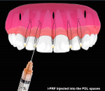 Fig 17. Illustration demonstrating injection of i-PRF into the PDL on the mesial and distal of each tooth being treated before patient is dismissed from the surgical appointment.