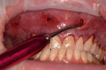Fig 10. Soft-tissue piercing instrument creating entrance holes in the mucosa apical to the mucogingival line.