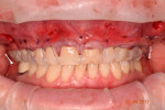 Fig 15. Apical mattress sutures placed at composite at the contacts between the teeth to stabilize the soft tissue.