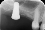 Fig 2. Periapical radiograph of site No. 3 showed RBH of 4 mm with a relatively flat sinus floor.
