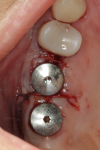Fig 7. Soft-tissue closure after implant placement in site No. 3.