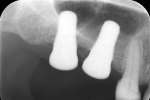 Fig 10. Four months after implant placement, periapical radiograph showed signs of partially mineralized bone in the sinus. The implant was clinically immobile and deemed to be osseointegrated.