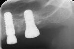 Fig 16. Periapical radiograph immediately after implant placement at sites Nos. 12 and 13.