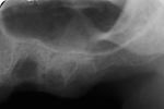 Fig 15. Preoperative periapical radiograph of sites Nos. 12 and 13. Site No. 13 had about 3 mm RBH.