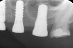 Fig 19. Postoperative periapical radiograph at site No. 14, which was treated with the presented procedure. Note visible bone fragment from elevation of the sinus floor (treatment performed by Dr. Viensuong Nguyen, UCONN prosthodontics resident).
