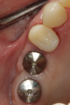 Fig 9. Healed site No. 3 at 4 months post implant placement.