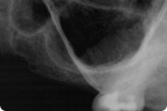 Fig 18. Preoperative periapical radiograph at sites Nos. 12 through 14. Site No. 14 had 2 mm RBH.