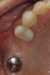 Fig 1. Occlusal view of edentulous site No. 3 indicated for implant placement. This patient had a previously placed implant at site No. 2 that was unrestored.