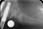 Fig 12. Preoperative periapical radiograph of sites Nos. 12 through 14. Site No. 14 had 1.8 mm RBH.
