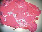 Figure 6  Histology showed notable trabeculation. The core was taken with a 2-mm trephine from the implant osteotomy.