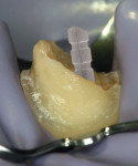 Figure 3  The post color disappears after cementation; it actually becomes translucent. Should the post need to be removed, simply access the end and spray cold water on it—the color reappears.