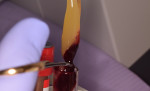 Fig 1. Fibrin clot being removed from the centrifuged tube with use of tweezers.