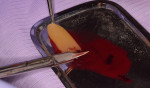 Fig 2. Fibrin clot separation using scissors to remove most of RBC attached to the clot.