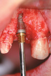 Figure 8  A 4-mm x 13-mm NanoTite Certain Implant was placed immediately into the extraction site. Note the significant dehiscence, resulting in exposed facial threads.