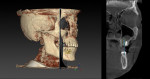 Preoperative 3D digital planning is an important diagnostic tool to support a prosthetically-driven implant insertion.