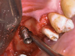 Implant removal.