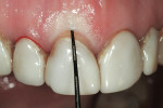 Figure 5  Sounding measurement, right central incisor.