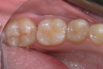 Preoperative occlusal view of tooth No. 19.