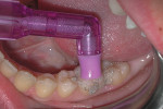 Cleaning of the tooth with coarse pumice and
a disposable prophy angle cup.