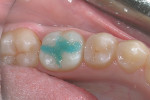 The etchant on the occlusal surface is allowed to react for 20 seconds.