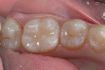 Cured BioCoat sealant in place on tooth No. 19. Although the natural white color is clearly distinguishable from enamel in a dry environment, in a wet field, it blends indistinguishably.
