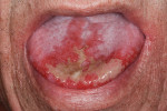 Fig 1. Example of a typical case of oral mucositis.