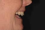 Fig 9. Lateral full smile pretreatment.