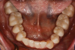 Fig 16. Mandibular occlusal view post-treatment.