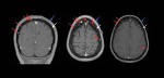 Fig 2. Patient’s coronal (left) and axial (center and right) T1 fat-saturated contrast-enhanced sequence magnetic resonance image. Red arrows point to MM lytic lesions, blue arrows identify soft tissue of head, and white arrows highlight cranial bone.