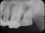 Fig 7. Postsurgical periapical radiograph.