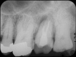 Fig 2. Preoperative periapical radiograph.