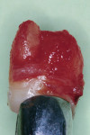 Fig 4. Donor tooth No. 16 with healthy periodontal tissues.