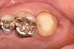 Fig 8. Intraoral transplanted tooth 3 months after the surgery.