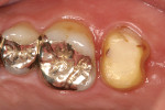Fig 9. Intraoral transplanted tooth for impression 9 months after the surgery.