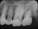 Fig 11. Periapical radiograph 9 months after the surgery.