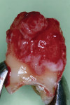 Fig 5. Extracted tooth No. 15 with root fracture and infected periodontal granulation tissue.