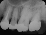 Fig 12. Periapical radiograph 2 years after the surgery.