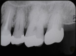 Fig 13. Periapical radiograph 4 years after the surgery.