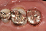 Fig 10. Final restoration on the transplanted tooth. Occlusal adjustments were made to ensure adequate occlusion.