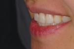 Fig 9. A sagittal angle of worn teeth shows the loss of embrasure space.