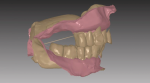 Fig 2. Sagittal view of reference dentition is shown in relation to anterior and posterior ridges. Patient desires ideal anterior esthetic arrangement.