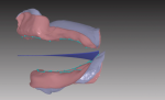 Fig 7. Sagittal view of ridge relationship and virtual set-up template in relation to retromolar pads.