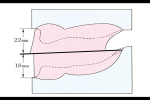 Fig 8. This illustration shows the average intervestibular measurement of 40 mm.