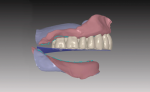 Fig 11. The sagittal view of maxillary teeth is set to a virtual occlusal template in a lingualized scheme.